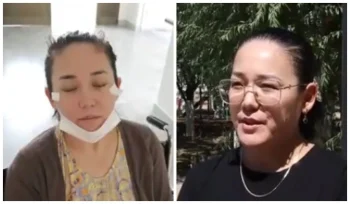 Ботокс жасатқан қызылордалық әйелдің көзі көрмей қалған